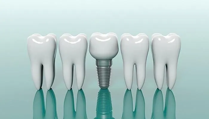 Dental implants