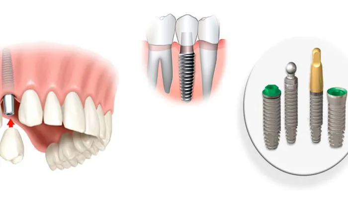 Dental implants