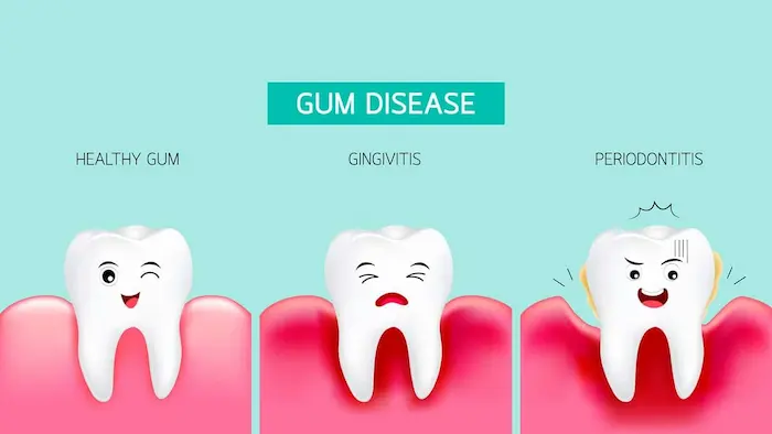 Gum disease