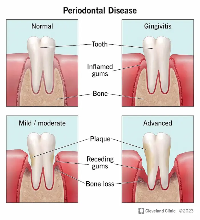 Gum disease