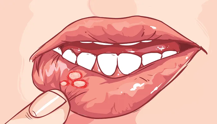 mouth ulcers