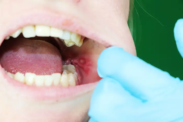 Mouth infections