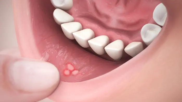 Mouth infections