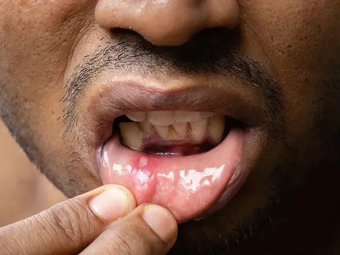 Mouth infections