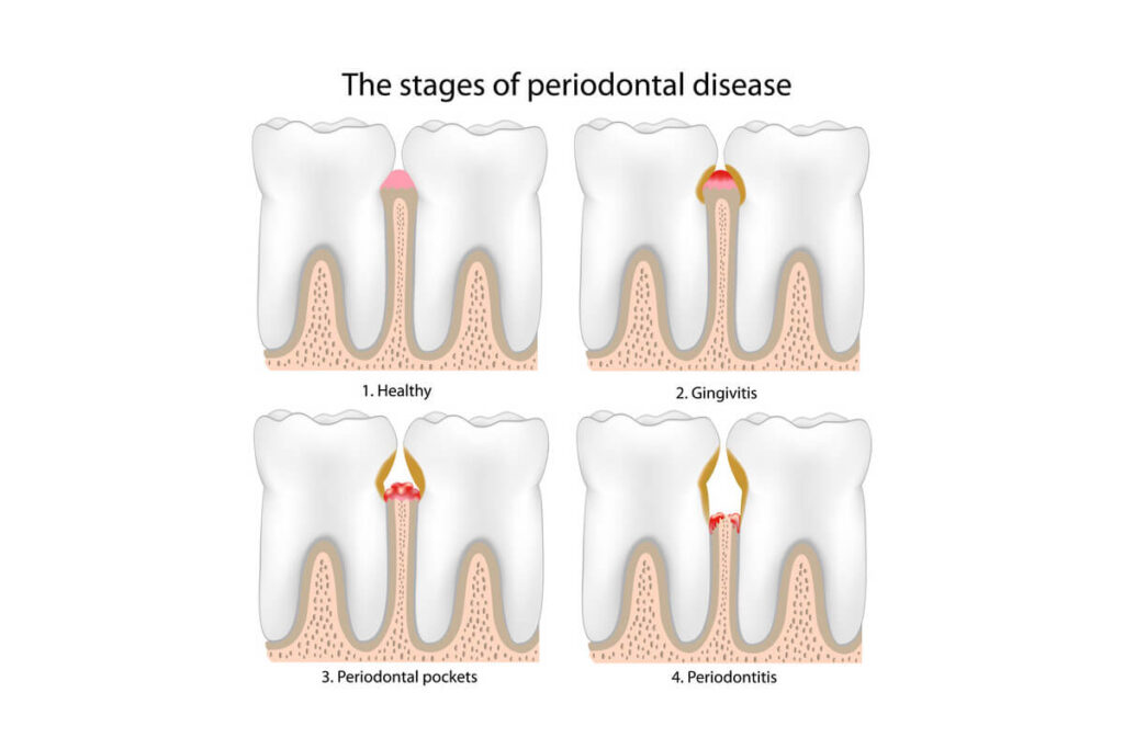 Types of periodontal disease