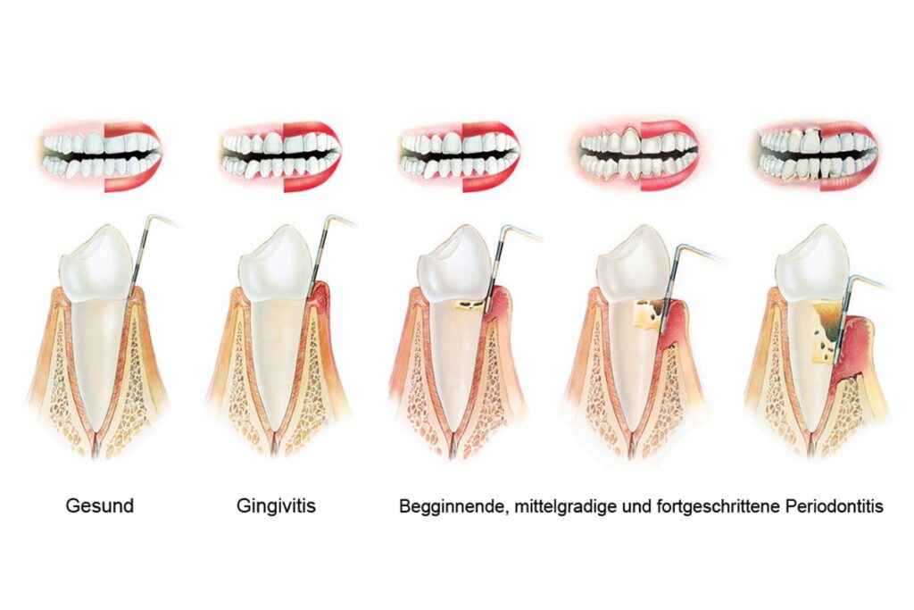 Types of periodontal disease