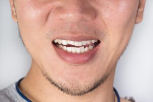 Treatment options for a cracked tooth