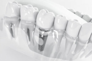  dental implants cost comparison guide