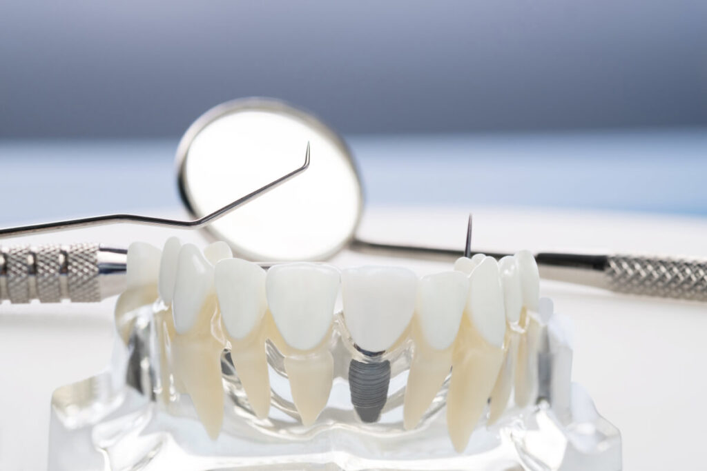 dental implants cost comparison guide