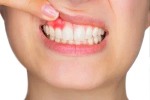 how to prevent gum disease in adults