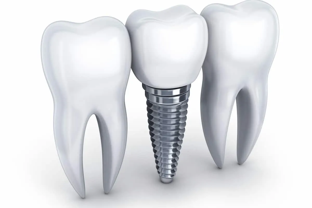  dental implants cost comparison guide