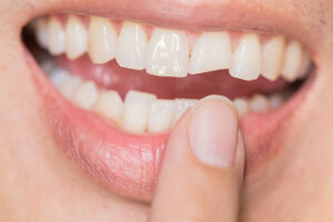 Treatment options for a cracked tooth