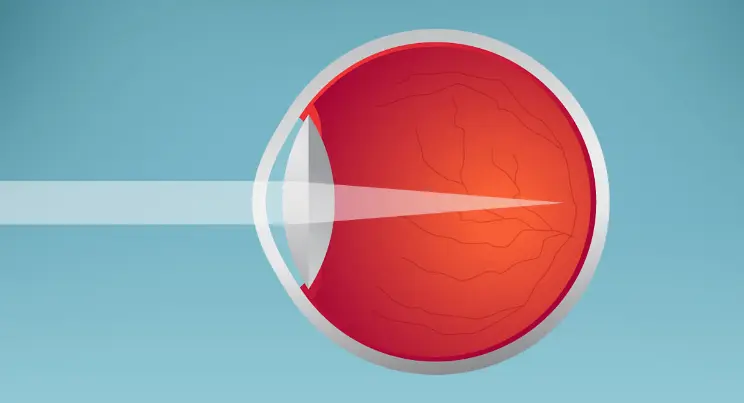 what causes nearsightedness