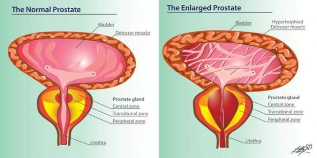 Prostatic Fluid